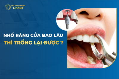 nhổ răng bao lâu thì trồng lại được