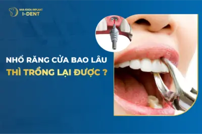 nhổ răng bao lâu thì trồng lại được