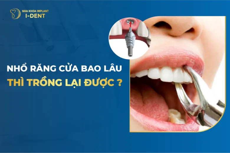 nhổ răng bao lâu thì trồng lại được