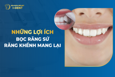 Những Lợi Ích Bọc Răng Sứ Răng Khểnh Mang Lại