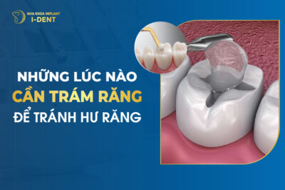 Những Lúc Nào Cần Phải Trám Răng Để Tránh Hư Răng