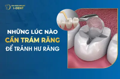 Những Lúc Nào Cần Phải Trám Răng Để Tránh Hư Răng