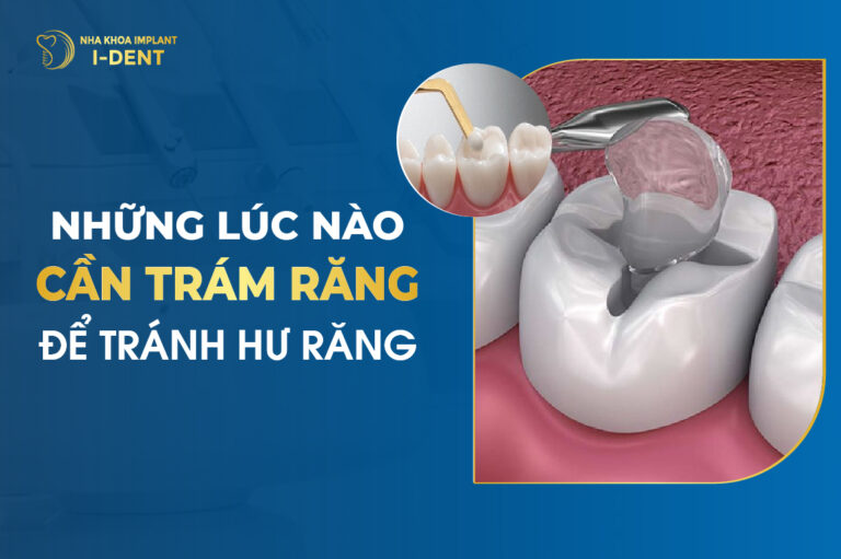 Những Lúc Nào Cần Phải Trám Răng Để Tránh Hư Răng