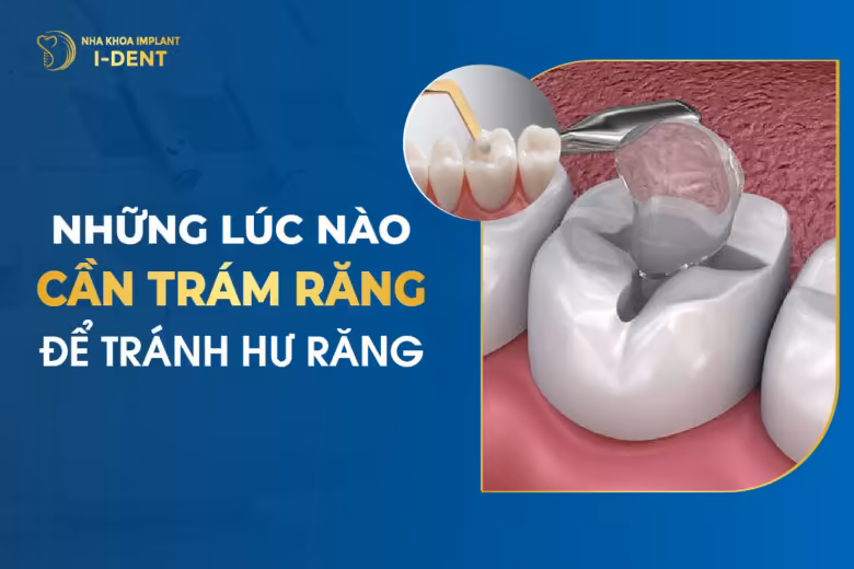 Những Lúc Nào Cần Phải Trám Răng Để Tránh Hư Răng
