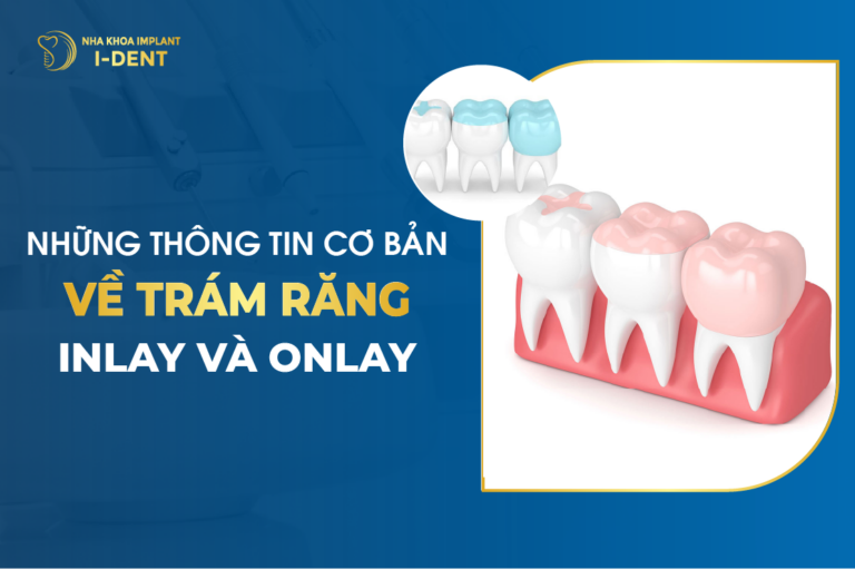 Những Thông Tin Cơ Bản Về Trám răng Inlay Và Onlay