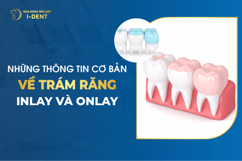 Những Thông Tin Cơ Bản Về Trám răng Inlay Và Onlay