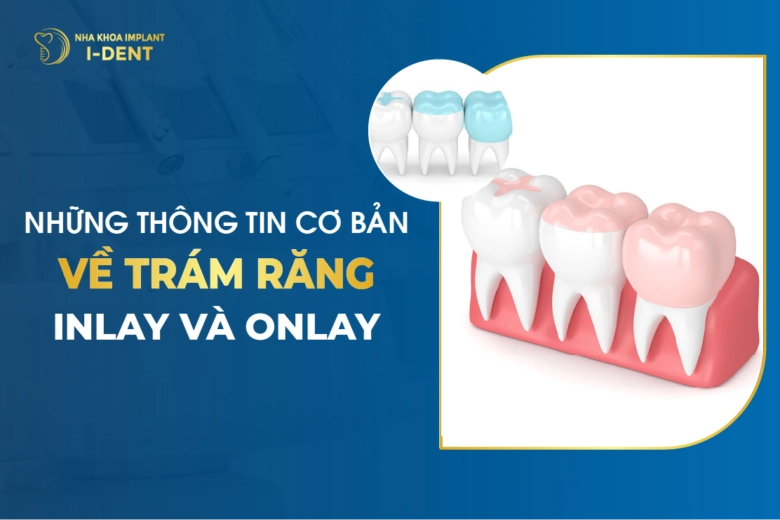 Những Thông Tin Cơ Bản Về Trám răng Inlay Và Onlay