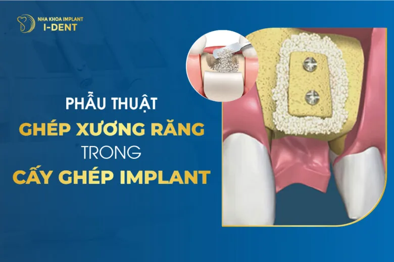 ghép xương răng