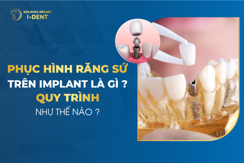 Phục hình răng sứ trên implant là gì? Quy trình như thế nào?