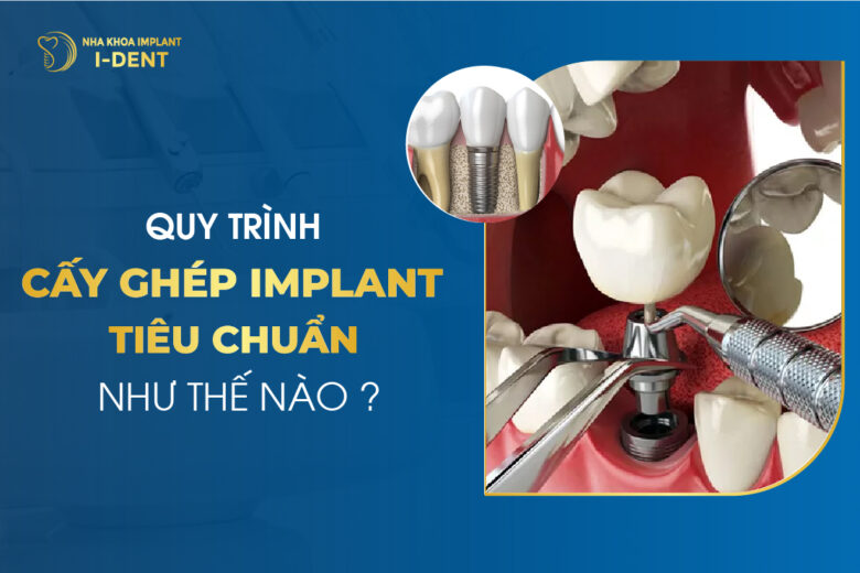 Quy Trình Cấy Ghép Implant Tiêu Chuẩn Như Thế Nào?