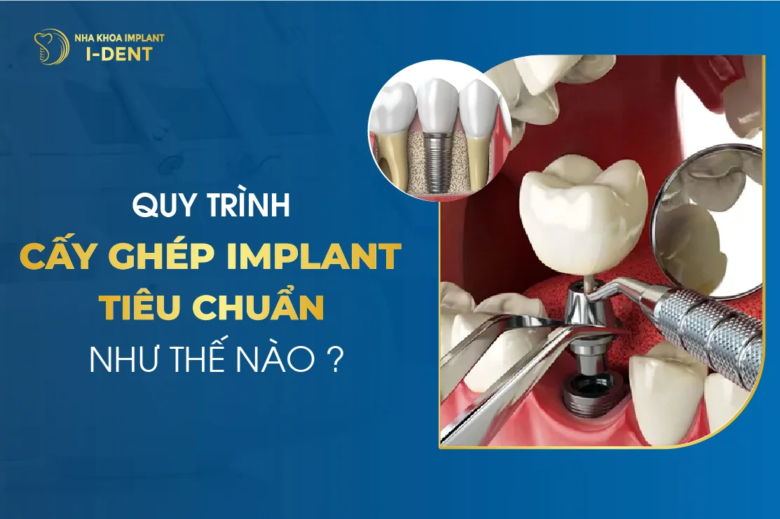 quy trình trồng răng implant