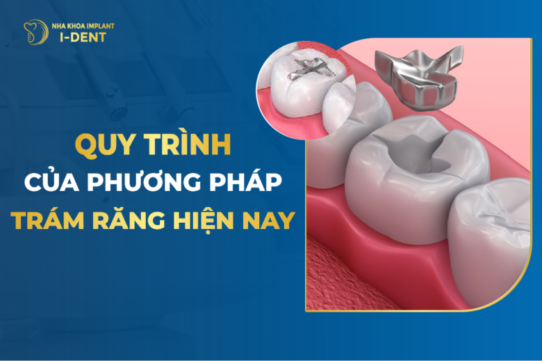 Quy Trình Của Phương Pháp Trám Răng Hiện Nay