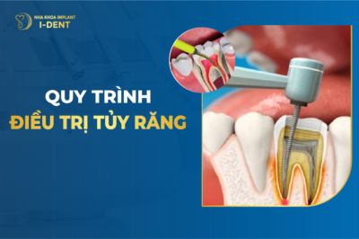 Quy Trình Điều Trị Tủy Răng