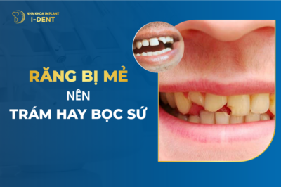 Răng Bị Mẻ Nên Trám Hay Bọc Sứ ?