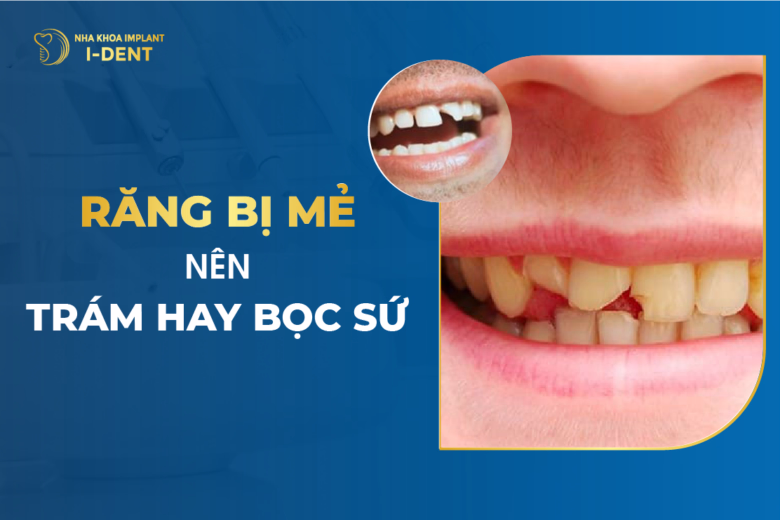 Răng Bị Mẻ Nên Trám Hay Bọc Sứ ?