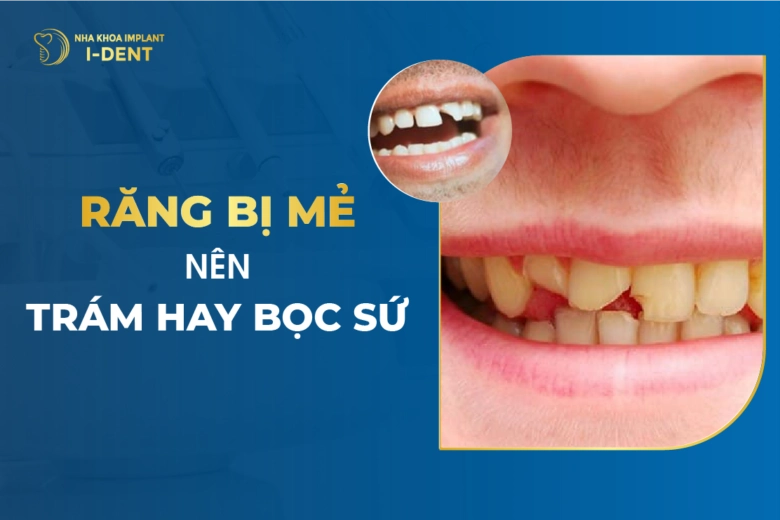 Răng Bị Mẻ Nên Trám Hay Bọc Sứ ?