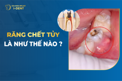 Răng Chết Tủy Là Như Thế Nào