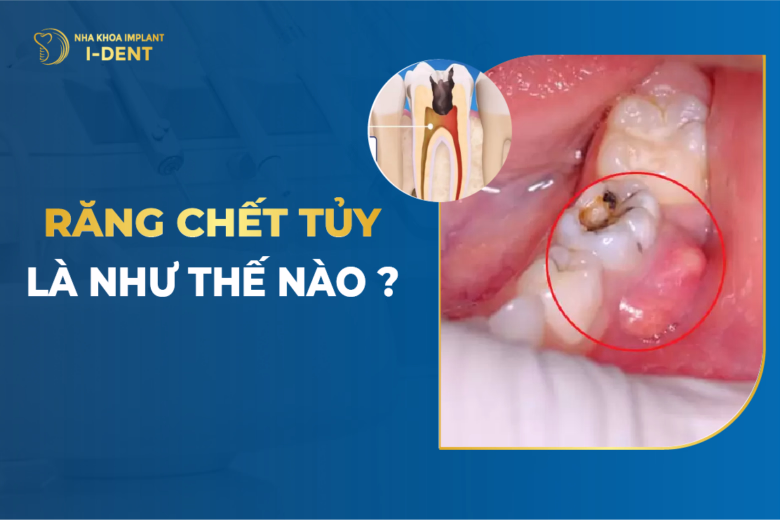 Răng Chết Tủy Là Như Thế Nào