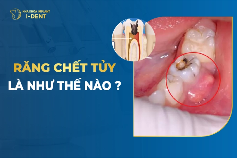 Răng Chết Tủy Là Như Thế Nào