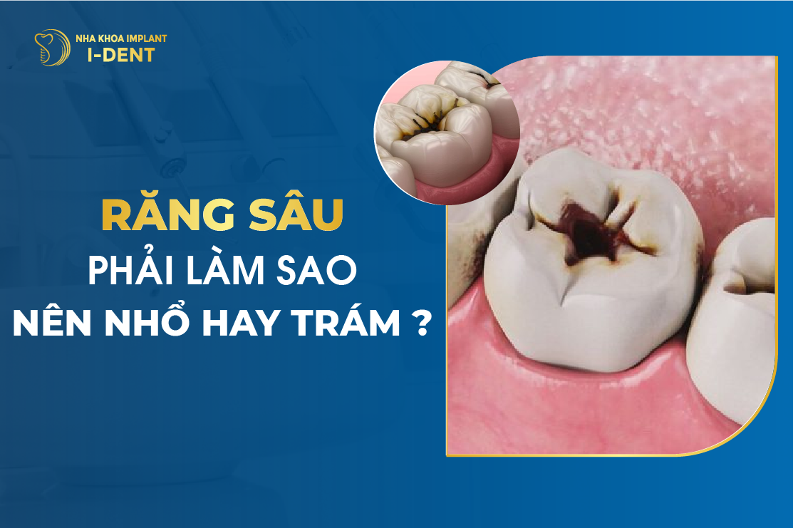 Răng sâu nên trám hay nhổ: Lựa chọn nào tốt nhất cho bạn?