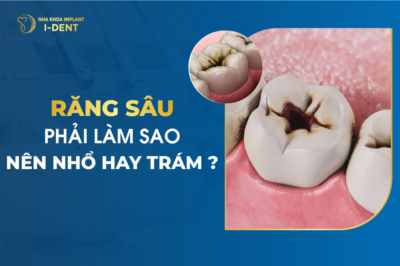 Răng Sâu Phải Làm Sao - Nên Nhổ Hay Trám?