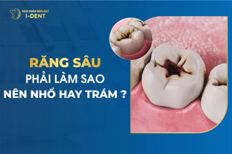 Răng Sâu Phải Làm Sao - Nên Nhổ Hay Trám?
