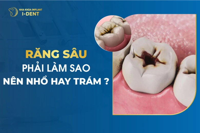 Răng Sâu Phải Làm Sao - Nên Nhổ Hay Trám?