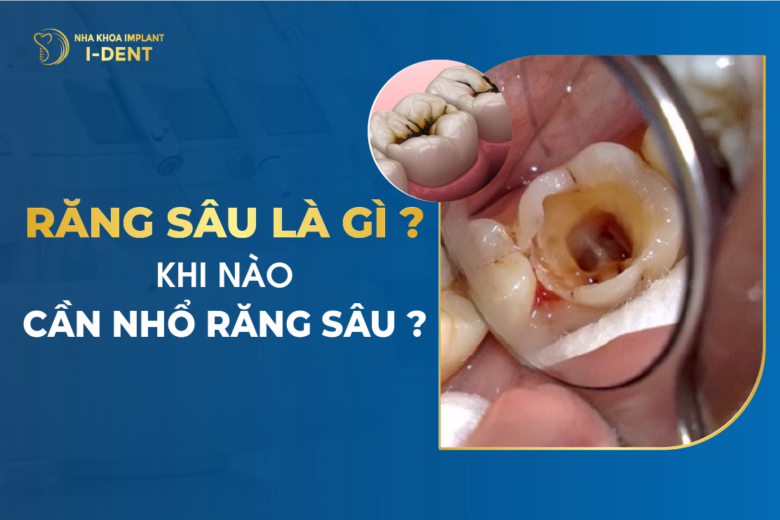 Răng Sâu là Gì? Khi Nào Cần Nhổ Răng Sâu?