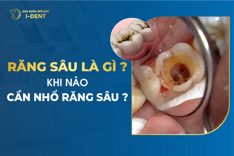 Răng Sâu là Gì? Khi Nào Cần Nhổ Răng Sâu?