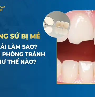 Răng Sứ Bị Mẻ Phải Làm Sao- Cách Phòng Tránh Như Thế Nào-