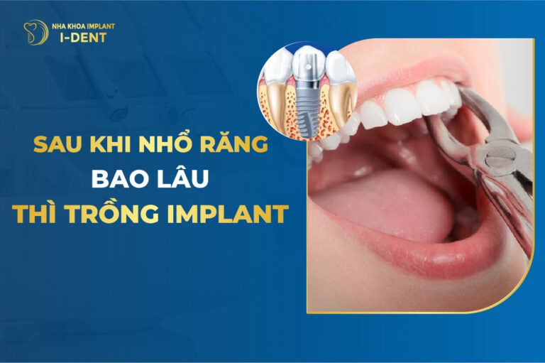 sau khi nhổ răng bao lâu thì trồng implant