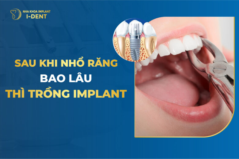 Sau Khi Nhổ Răng Bao Lâu Thì Trồng Implant?