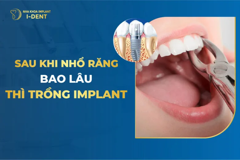 sau khi nhổ răng bao lâu thì trồng implant