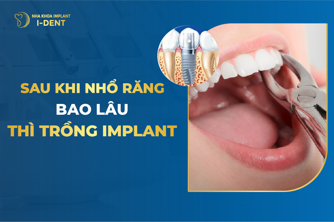 Sau khi nhổ răng bao lâu thì có thể trồng implant?
