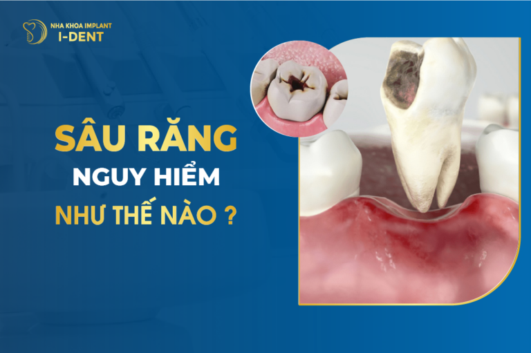 Sâu Răng Nguy Hiểm Như Thế Nào