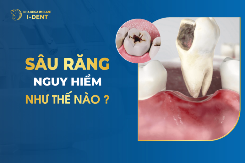 Sâu Răng Nguy Hiểm Như Thế Nào