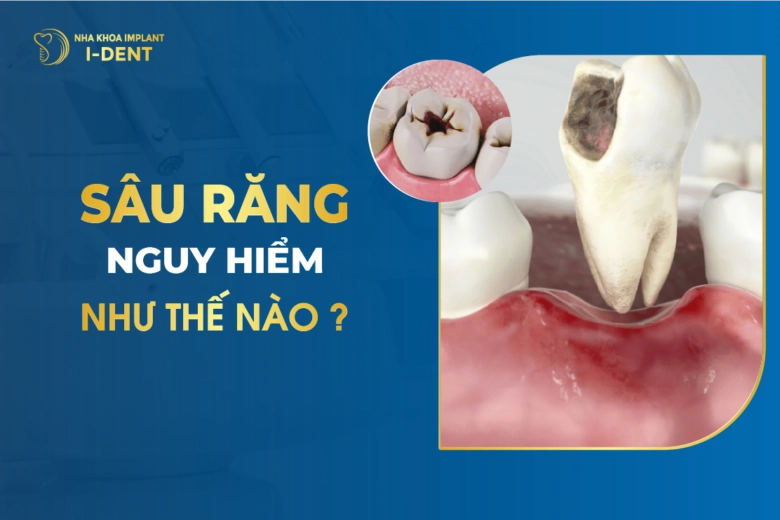 Sâu Răng Nguy Hiểm Như Thế Nào