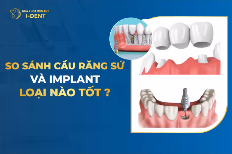 cầu răng và implant