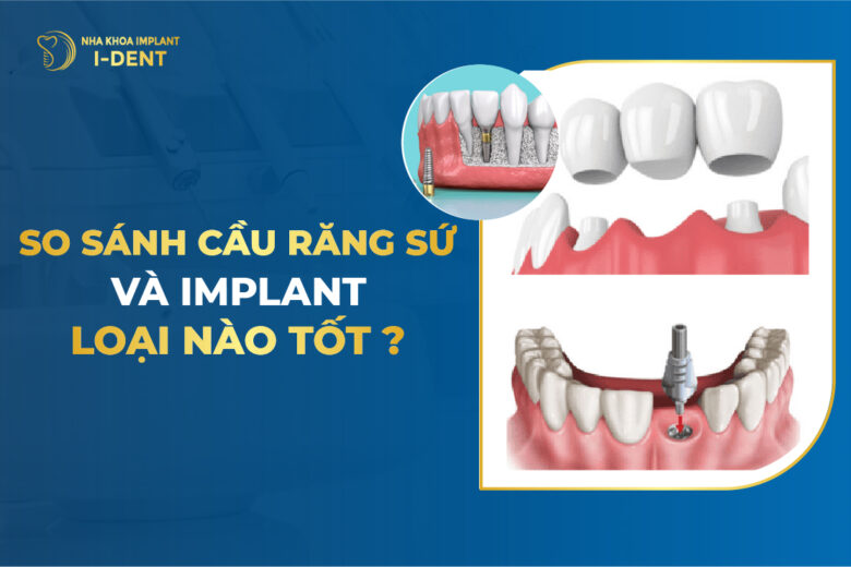 So Sánh Cầu Răng Sứ Và Implant Loại Nào Tốt?