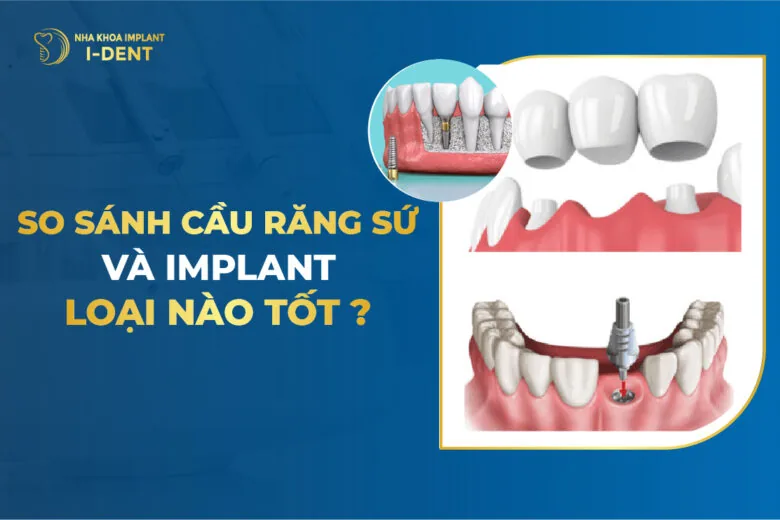 cầu răng và implant