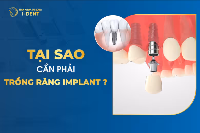 Tại Sao Cần Phải Trồng Răng Implant