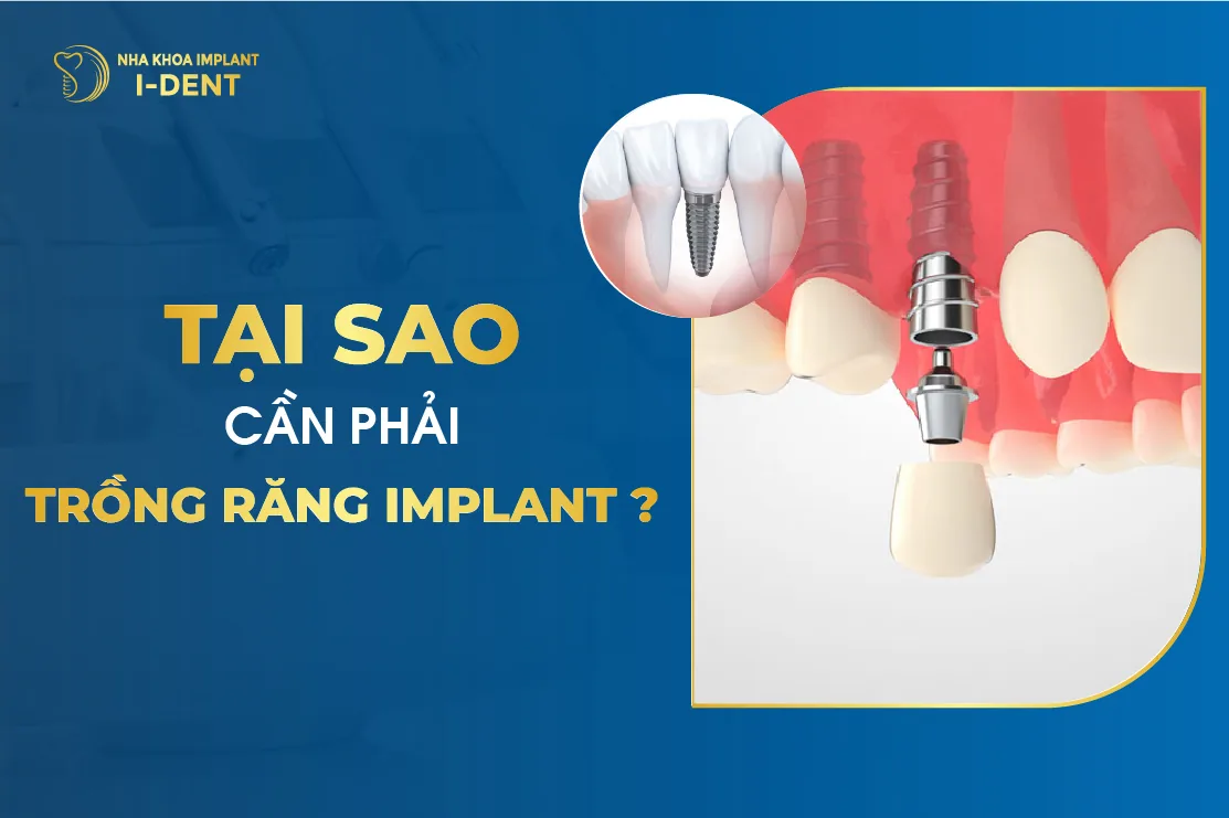 Tại Sao Cần Phải Trồng Răng Implant