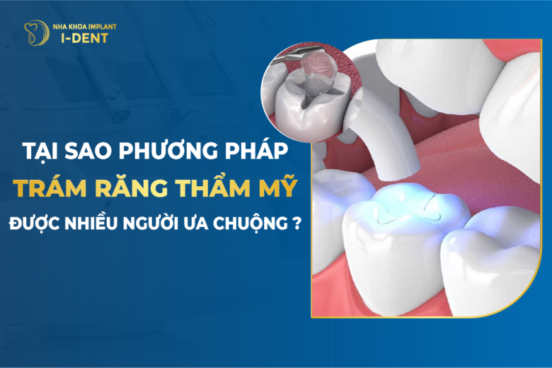 Tại Sao Phương Pháp Trám Răng Thẩm Mỹ Được Nhiều Người Ưa Chuộng ?