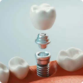 Tặng Mão Răng Sứ Trên Implant