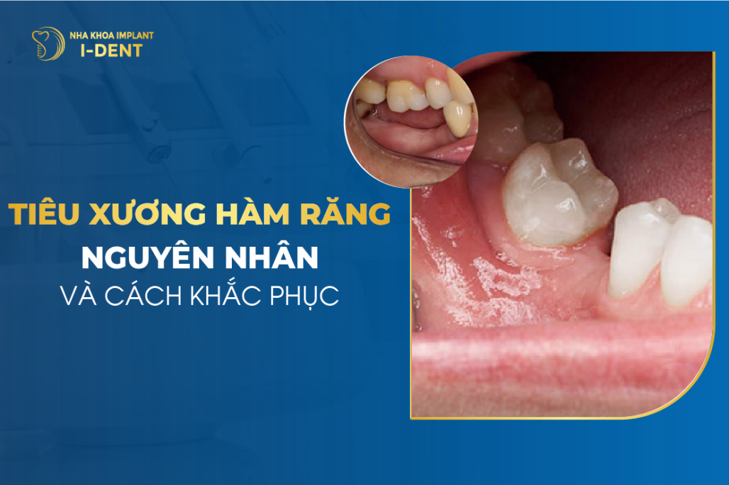 tiêu xương hàm
