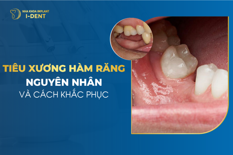 Tiêu Xương Hàm Răng – Nguyên Nhân Và Cách Khắc Phục