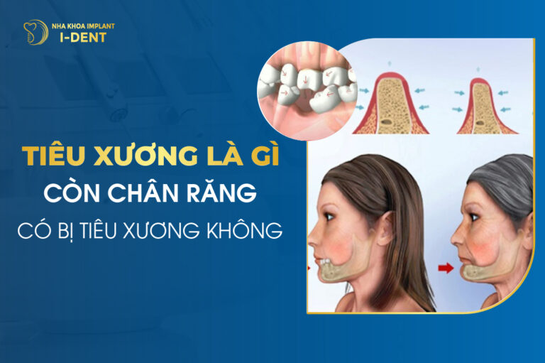 Tiêu Xương Là Gì Còn Chân Răng Có Bị Tiêu Xương Không