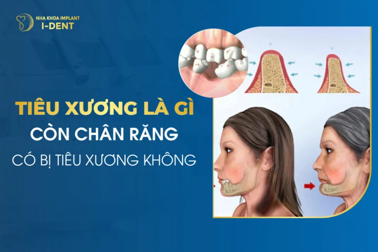 Tiêu Xương Là Gì Còn Chân Răng Có Bị Tiêu Xương Không