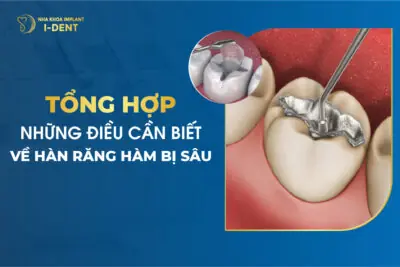 Tổng Hợp Những Điều Cần Biết Về Hàn Răng Hàm Bị Sâu