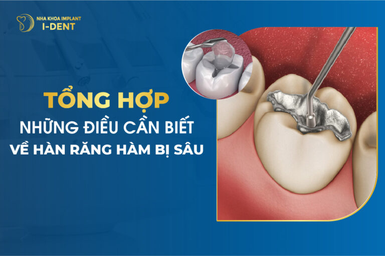 Tổng Hợp Những Điều Cần Biết Về Hàn Răng Hàm Bị Sâu